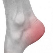Osteoarrozni davolash